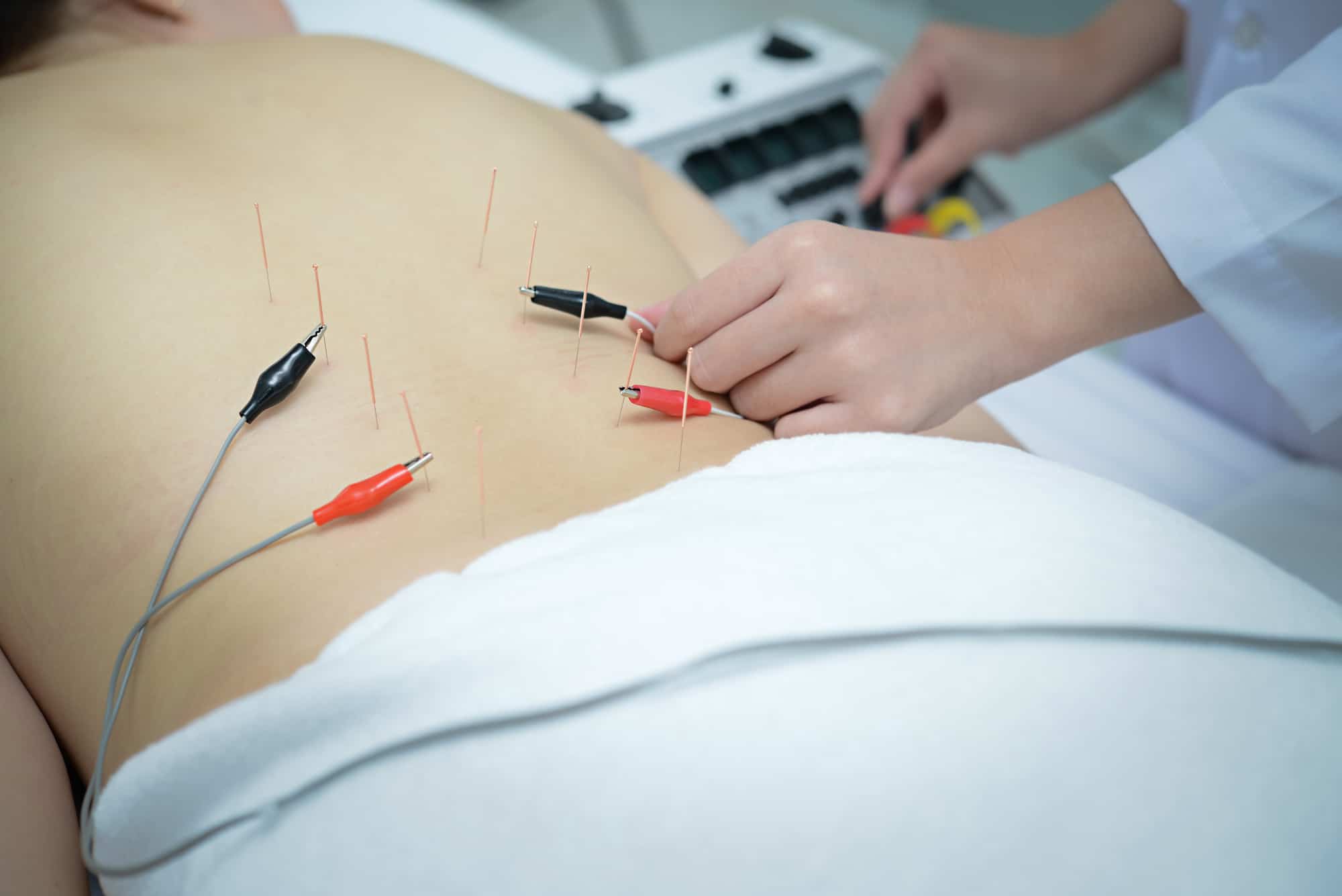 Electric Needle Acupuncture Boise - Supercharged Pain Relief