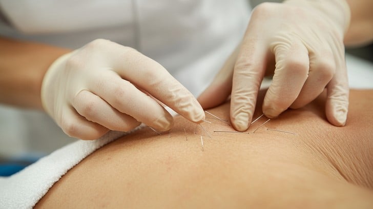 Traditional Acupuncture Treatment in Boise - Ancient Healing for Modern Pain